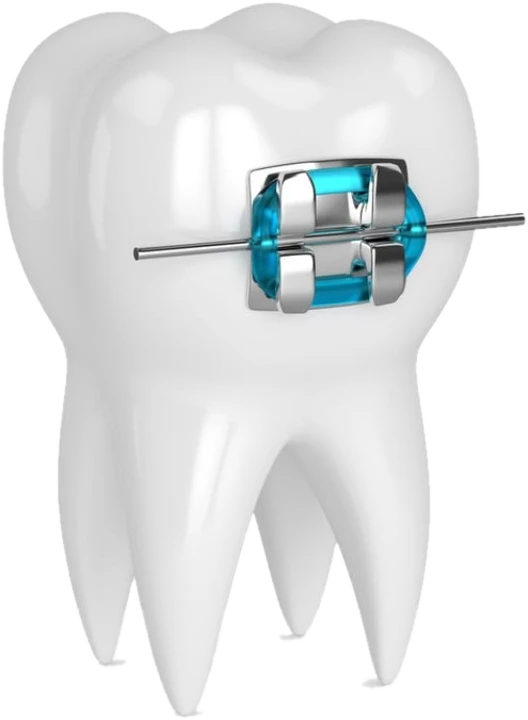Dente com aparelho ortodôntico metálico